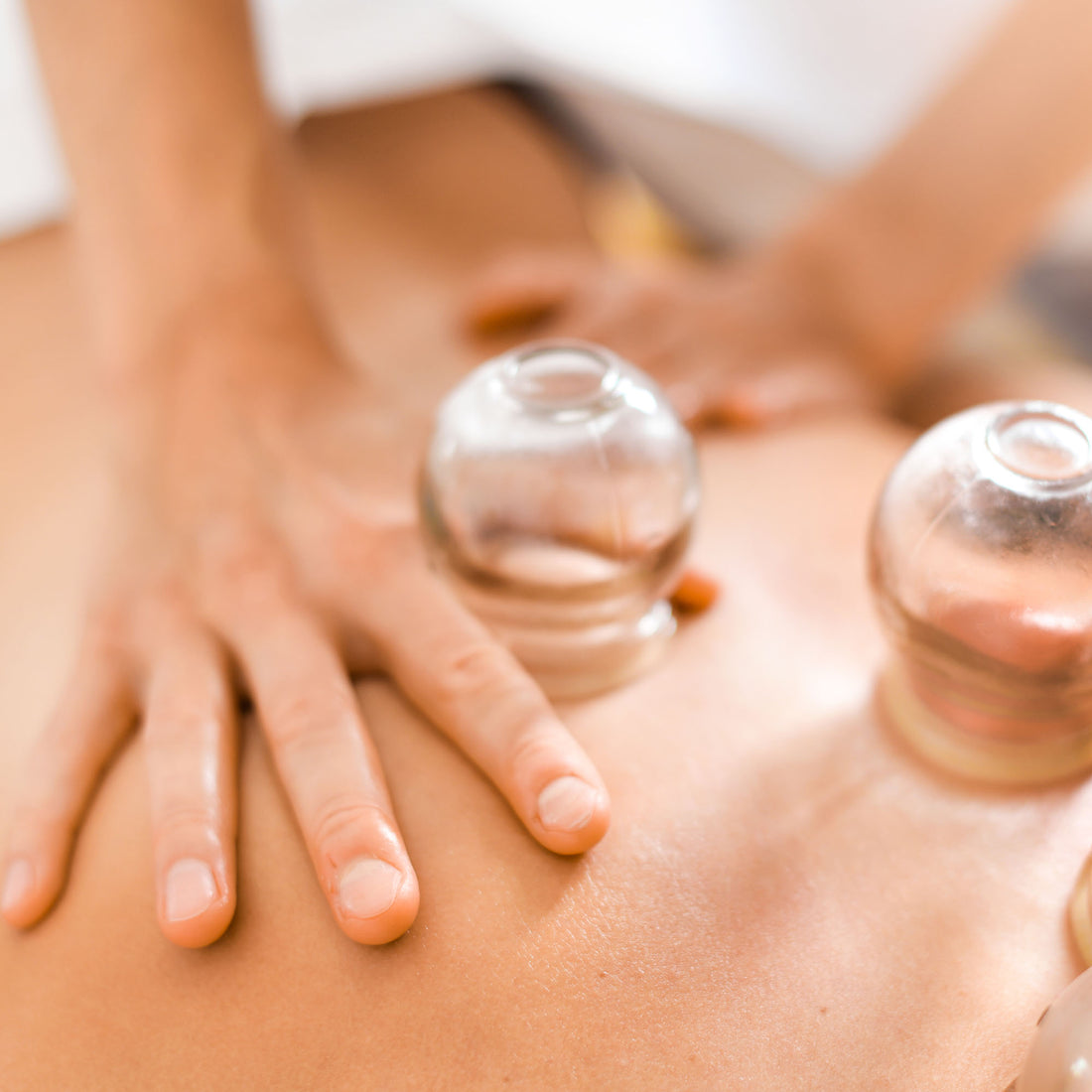 Cupping