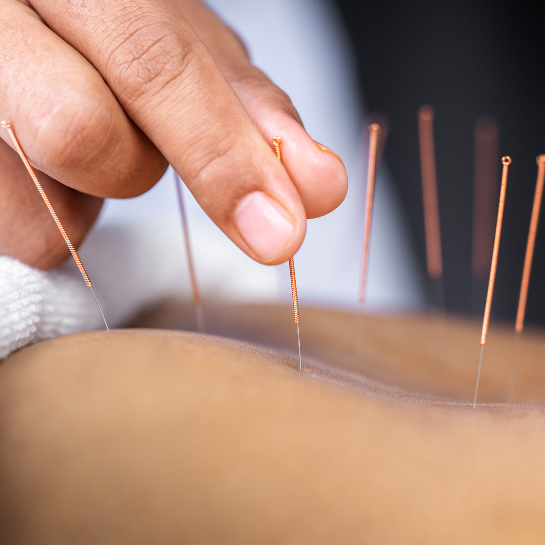 Acupuncture